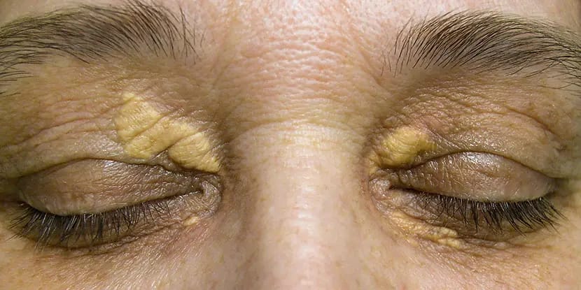 झॅन्थेलाझ्मा (XANTHELASMA)
